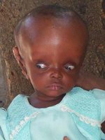 hydrocephalus.jpg